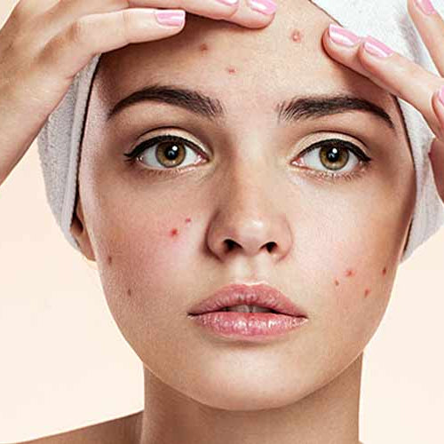 Ideal Skincare Routine For Oily And Acne-Prone Skin