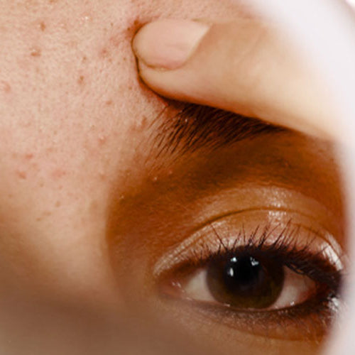 Five Common Skincare Mistakes That Are Making Your Acne Worse