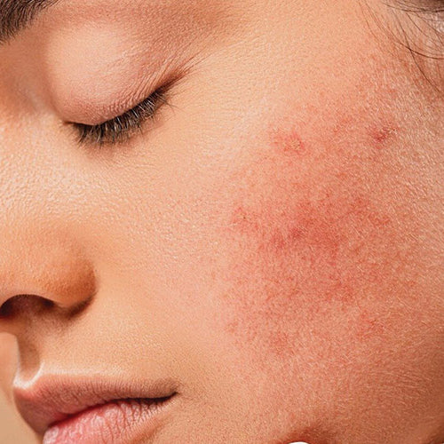 Top Anti-Acne Ingredients To Include In Your Skincare