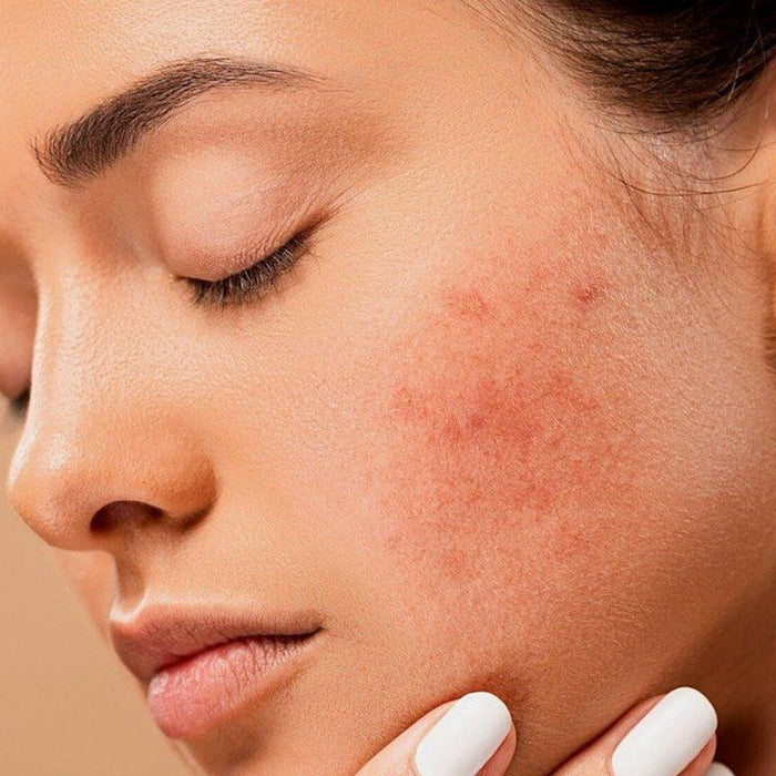 Easy Tips To Control Acne In Monsoon | Vanity Wagon
