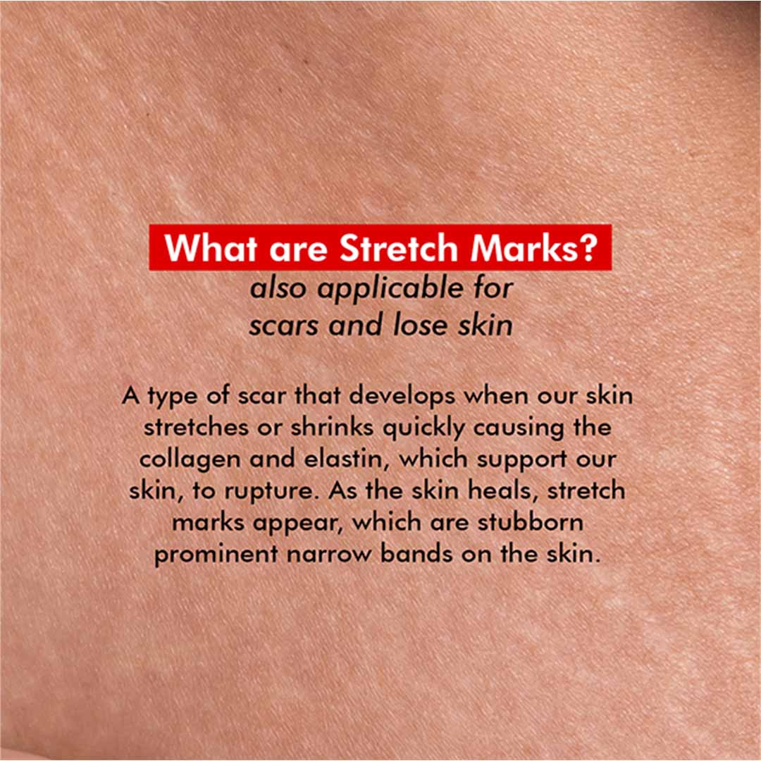 Conscious Chemist® Retinol Body Cream For Stretch marks, Uneven Skin Tone & Scars