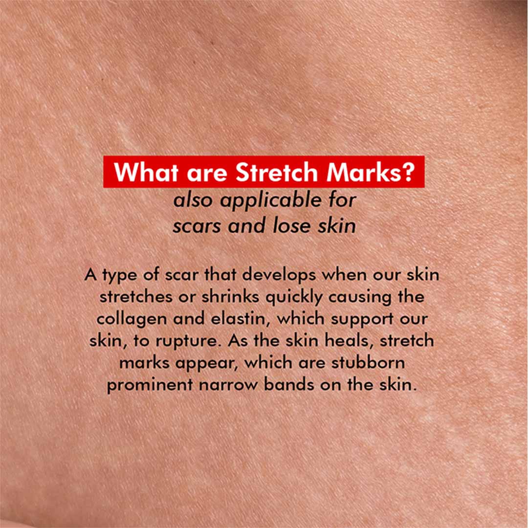 Conscious Chemist® Retinol Body Cream For Stretch marks, Uneven Skin Tone & Scars - Super Saver Pack