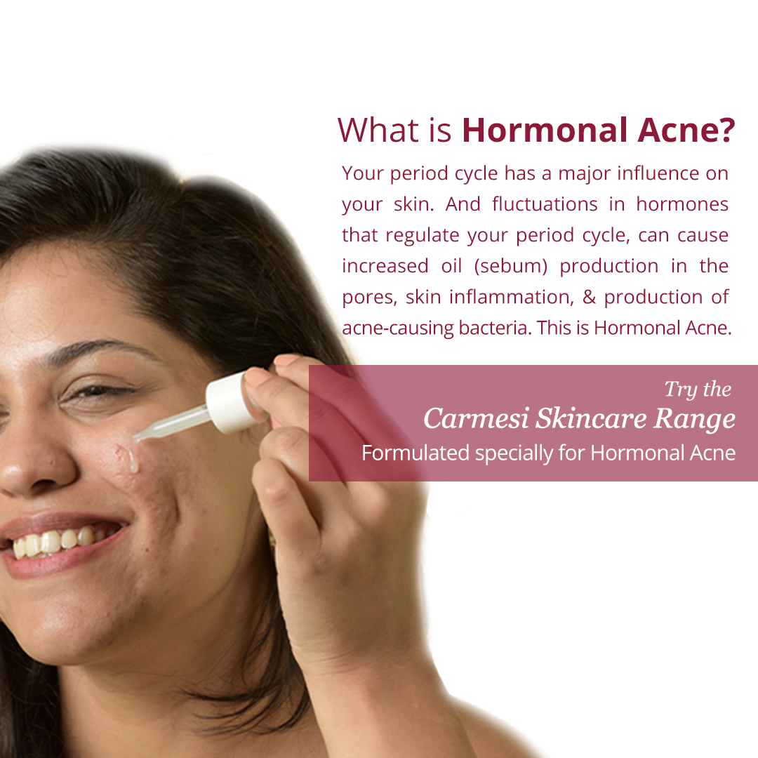 Vanity Wagon | Buy Carmesi Blemish Reducing Serum For Hormonal Acne