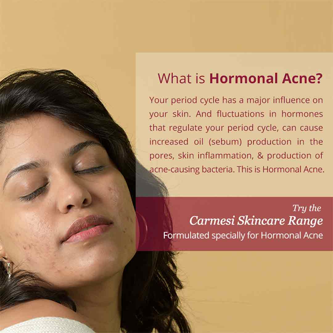 Vanity Wagon | Buy Carmesi Pore Clarifying Toner for Hormonal Acne